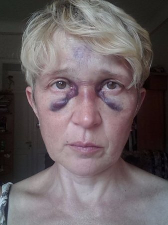 Цивилизованная Цэевропа: в Одессе избита известная журналистка